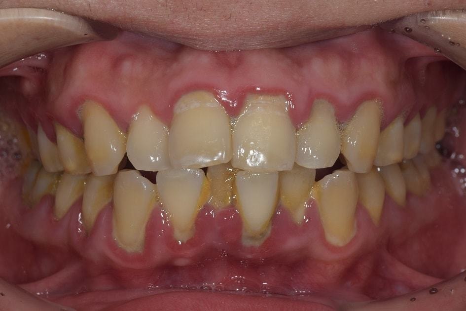歯周病治療の重要性