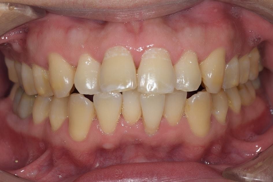歯周病治療の重要性