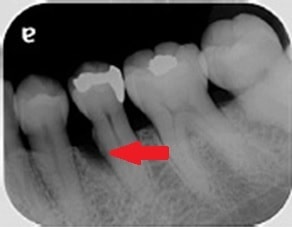 歯周病組織再生治療