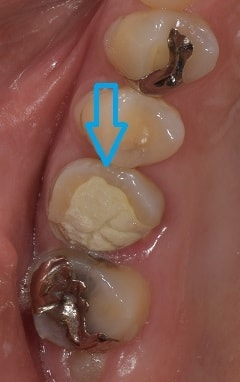 根管治療