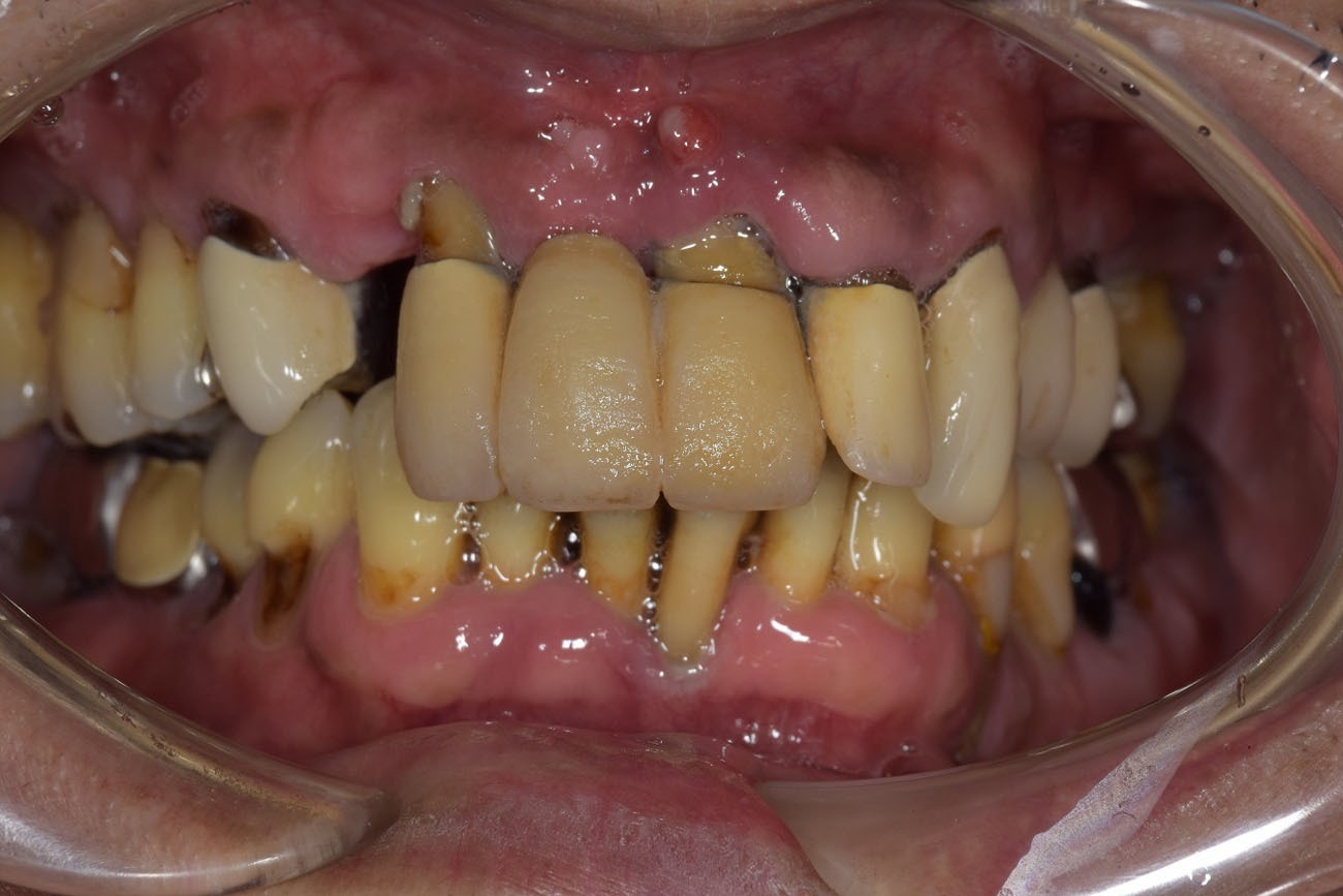 重度の歯周病治療例